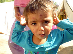 避難所の子ども。顔に皮膚病の症状が見られます